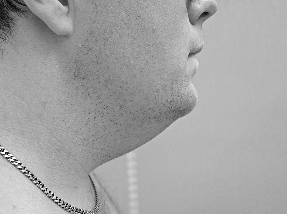 Fettsugning haka/hals - estetisk plastikkirurgi